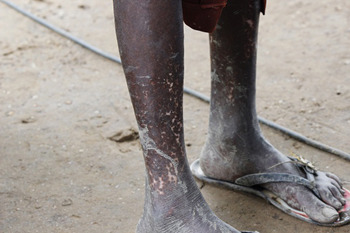 Depigmentation of the skin caused by onchocerciasis